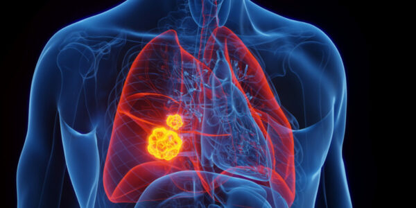 Lung Cancer Drug Elicits Unprecedented Results in New Trial