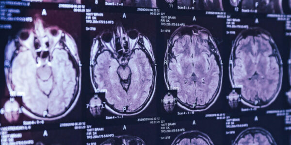 Top Canadian scientist alleges in leaked emails he was barred from studying mystery brain illness