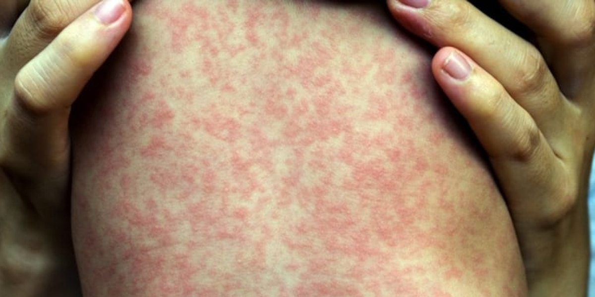 Measles ‘out of control,’ experts warn, as Alberta case counts surpass 1,000