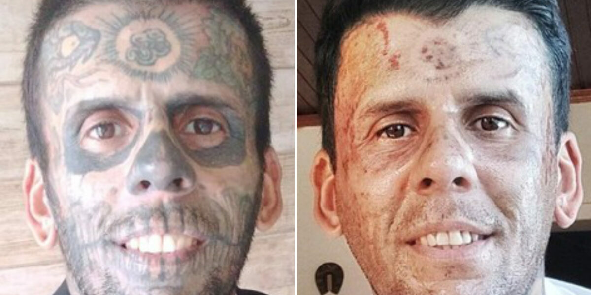 Man with tattoos on 95% of his body documents painstaking removal process