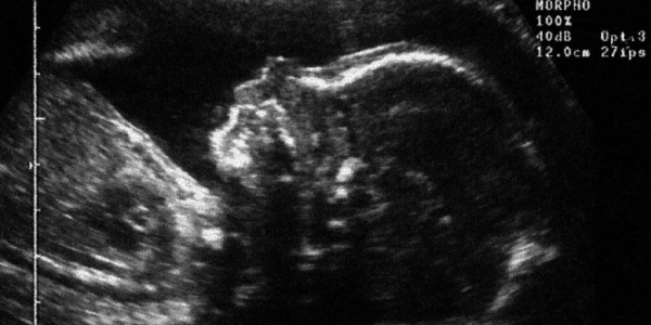 Late-term abortions are being performed in Canada without a serious medical reason